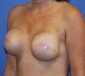 Patient 561 - Surgery 1 Photo 2 - Tissue Expander Implant - Breast Cancer Texas