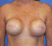 Patient 561 - Surgery 1 Photo 3 - Tissue Expander Implant - Breast Cancer Texas