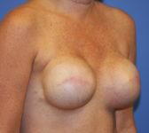 Patient 561 - Surgery 1 Photo 4 - Tissue Expander Implant - Breast Cancer Texas