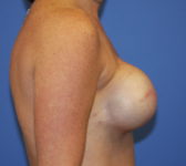 Patient 561 - Surgery 1 Photo 5 - Tissue Expander Implant - Breast Cancer Texas