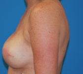 Patient 561 - Surgery 2 Photo 1 - Tissue Expander Implant - Breast Cancer Texas