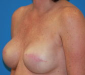 Patient 561 - Surgery 2 Photo 2 - Tissue Expander Implant - Breast Cancer Texas