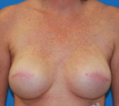 Patient 561 - Surgery 2 Photo 3 - Tissue Expander Implant - Breast Cancer Texas