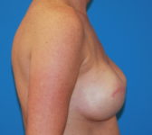 Patient 561 - Surgery 2 Photo 5 - Tissue Expander Implant - Breast Cancer Texas