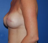 Patient 561 - Surgery 3 Photo 1 - Tissue Expander Implant - Breast Cancer Texas