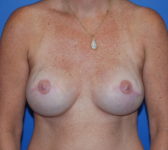 Patient 561 - Surgery 4 Photo 3 - Tissue Expander Implant - Breast Cancer Texas