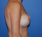 Patient 561 - Surgery 4 Photo 5 - Tissue Expander Implant - Breast Cancer Texas