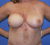 Patient 449 - Surgery 2 Photo 3 - Mastopexy DIEP Flap Surgery - Breast Cancer Texas
