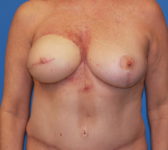 Patient 449 - Surgery 3 Photo 3 - Mastopexy DIEP Flap Surgery - Breast Cancer Texas