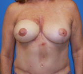 Patient 449 - Surgery 4 Photo 3 - Mastopexy DIEP Flap Surgery - Breast Cancer Texas