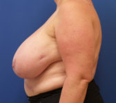 Patient 134 Before Surgey Photo 1 - Breast Reduction Lumpectomy Breast Reduction-Lift - Breast Cancer Texas