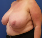 Patient 134 Before Surgey Photo 2 - Breast Reduction Lumpectomy Breast Reduction-Lift - Breast Cancer Texas