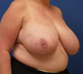 Patient 134 Before Surgey Photo 4 - Breast Reduction Lumpectomy Breast Reduction-Lift - Breast Cancer Texas
