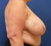 Patient 134 Before Surgey Photo 5 - Breast Reduction Lumpectomy Breast Reduction-Lift - Breast Cancer Texas