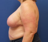 Patient 134 - Surgery 1 Photo 1 - Breast Reduction Lumpectomy Breast Reduction-Lift - Breast Cancer Texas
