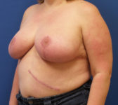 Patient 134 - Surgery 1 Photo 2 - Breast Reduction Lumpectomy Breast Reduction-Lift - Breast Cancer Texas