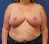 Patient 134 After Overview - Breast Reduction Lumpectomy Breast Reduction-Lift - Breast Cancer Texas
