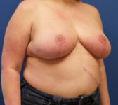 Patient 134 - Surgery 1 Photo 4 - Breast Reduction Lumpectomy Breast Reduction-Lift - Breast Cancer Texas