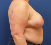 Patient 134 - Surgery 1 Photo 5 - Breast Reduction Lumpectomy Breast Reduction-Lift - Breast Cancer Texas