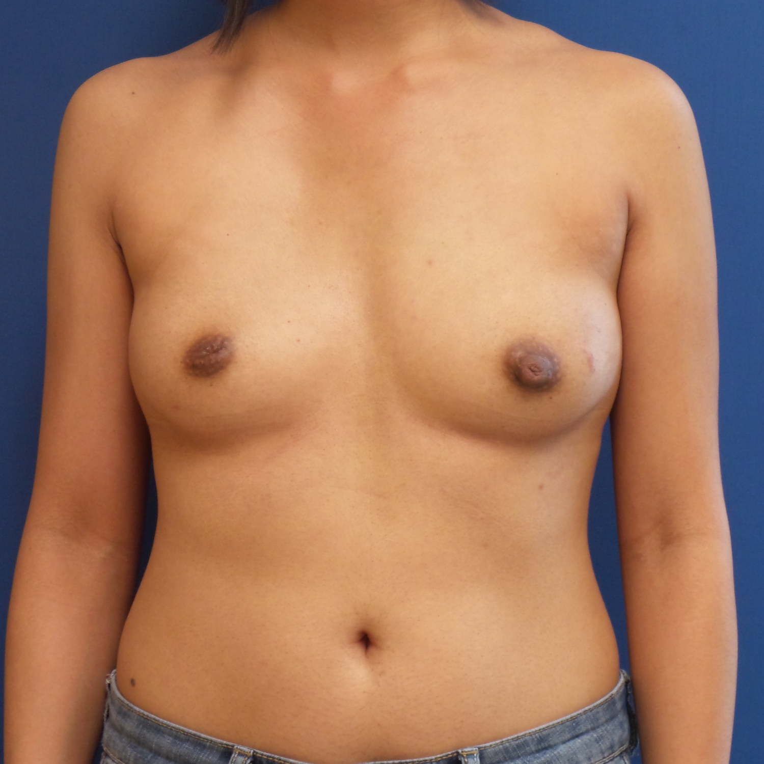 Patient 601 Before Overview - Sidebar - Nipple Sparing Mastectomy - Breast Cancer Texas
