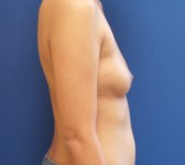 Patient 601 Before Surgey Photo 5 - Nipple Sparing Mastectomy - Breast Cancer Texas