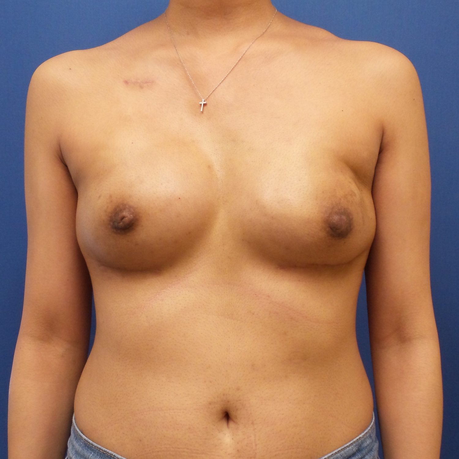 Patient 601 After Overview - Nipple Sparing Mastectomy - Breast Cancer Texas