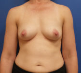 Patient 135 Before Surgey Photo 3 - Nipple Sparing Mastectomy Tissue Expander Implant - Breast Cancer Texas