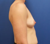 Patient 135 Before Surgey Photo 5 - Nipple Sparing Mastectomy Tissue Expander Implant - Breast Cancer Texas