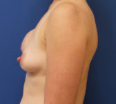 Patient 135 - Surgery 1 Photo 1 - Nipple Sparing Mastectomy Tissue Expander Implant - Breast Cancer Texas