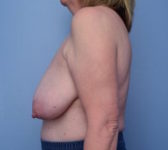Patient 150 Before Surgey Photo 1 - Breast Reduction Lumpectomy Breast Reduction-Lift - Breast Cancer Texas