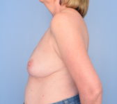 Patient 150 - 6 months out from completion of radiation therapy Photo 1 - Breast Reduction Lumpectomy Breast Reduction-Lift - Breast Cancer Texas