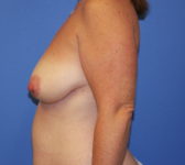 Patient 277 Before Surgey Photo 1 - Tissue Expander Implant - Breast Cancer Texas