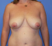 Patient 277 Before Surgey Photo 3 - Tissue Expander Implant - Breast Cancer Texas