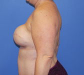 Patient 277 - Surgery 1 Photo 1 - Tissue Expander Implant - Breast Cancer Texas