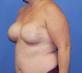 Patient 277 - Surgery 1 Photo 2 - Tissue Expander Implant - Breast Cancer Texas