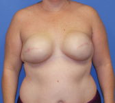 Patient 277 - Surgery 1 Photo 3 - Tissue Expander Implant - Breast Cancer Texas
