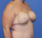 Patient 277 - Surgery 1 Photo 4 - Tissue Expander Implant - Breast Cancer Texas