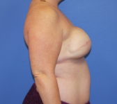 Patient 277 - Surgery 1 Photo 5 - Tissue Expander Implant - Breast Cancer Texas