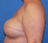 Patient 277 - Surgery 2 Photo 1 - Tissue Expander Implant - Breast Cancer Texas