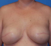 Patient 277 - Surgery 2 Photo 3 - Tissue Expander Implant - Breast Cancer Texas