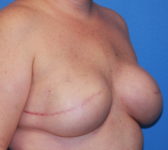 Patient 277 - Surgery 2 Photo 4 - Tissue Expander Implant - Breast Cancer Texas