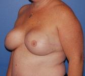 Patient 277 - Surgery 3 Photo 2 - Tissue Expander Implant - Breast Cancer Texas
