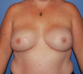 Patient 277 - Surgery 3 Photo 3 - Tissue Expander Implant - Breast Cancer Texas