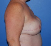 Patient 277 - Surgery 3 Photo 5 - Tissue Expander Implant - Breast Cancer Texas