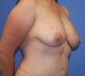 Patient 112 - Surgery 2 Photo 3 - DIEP Flap Surgery - Breast Cancer Texas