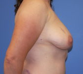 Patient 112 - Surgery 2 Photo 4 - DIEP Flap Surgery - Breast Cancer Texas