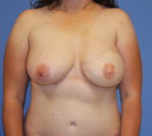 Patient 112 - Surgery 3 Photo 3 - DIEP Flap Surgery - Breast Cancer Texas