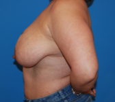 Patient 689 Before Surgey Photo 1 - Tissue Expander Implant Latissimus Muscle - Breast Cancer Texas