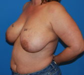 Patient 689 Before Surgey Photo 2 - Tissue Expander Implant Latissimus Muscle - Breast Cancer Texas
