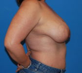Patient 689 Before Surgey Photo 5 - Tissue Expander Implant Latissimus Muscle - Breast Cancer Texas
